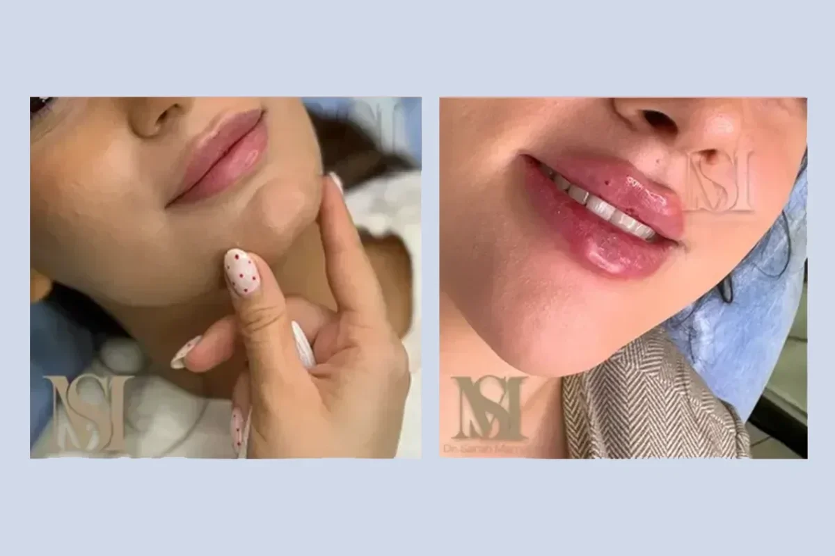 همه چیز درباره تزریق فیلر لب